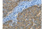 The image on the left is immunohistochemistry of paraffin-embedded Human liver cancer tissue using CSB-PA942155(BIN1 Antibody) at dilution 1/30, on the right is treated with fusion protein. (Original magnification: 