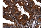 The image on the left is immunohistochemistry of paraffin-embedded Human cervical cancer tissue using CSB-PA942209(EGF Antibody) at dilution 1/60, on the right is treated with fusion protein. (Original magnification: 