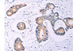 The image on the left is immunohistochemistry of paraffin-embedded Human colon cancer tissue using CSB-PA942397(ADCY5 Antibody) at dilution 1/30, on the right is treated with synthetic peptide. (Original magnification: 