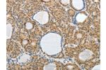 The image on the left is immunohistochemistry of paraffin-embedded Human thyroid cancer tissue using CSB-PA942495(AKAP6 Antibody) at dilution 1/30, on the right is treated with synthetic peptide. (Original magnification: 