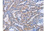 The image on the left is immunohistochemistry of paraffin-embedded Human thyroid cancer tissue using CSB-PA943255(CCR6 Antibody) at dilution 1/50, on the right is treated with synthetic peptide. (Original magnification: 