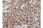 The image on the left is immunohistochemistry of paraffin-embedded Human esophagus cancer tissue using CSB-PA943275(AKAP8 Antibody) at dilution 1/30, on the right is treated with synthetic peptide. (Original magnification: 