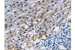 The image on the left is immunohistochemistry of paraffin-embedded Human liver cancer tissue using CSB-PA943355(GJB3 Antibody) at dilution 1/35, on the right is treated with synthetic peptide. (Original magnification: 
