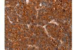 The image on the left is immunohistochemistry of paraffin-embedded Human liver cancer tissue using CSB-PA944210(GC Antibody) at dilution 1/30, on the right is treated with fusion protein. (Original magnification: 