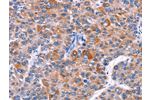 The image on the left is immunohistochemistry of paraffin-embedded Human liver cancer tissue using CSB-PA944356(ELP2 Antibody) at dilution 1/40, on the right is treated with fusion protein. (Original magnification: 