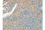 The image on the left is immunohistochemistry of paraffin-embedded Human liver cancer tissue using CSB-PA944495(CHRDL2 Antibody) at dilution 1/20, on the right is treated with synthetic peptide. (Original magnification: 
