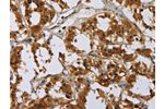 The image on the left is immunohistochemistry of paraffin-embedded Human thyroid cancer tissue using CSB-PA944675(GATA5 Antibody) at dilution 1/50, on the right is treated with synthetic peptide. (Original magnification: 