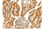 The image on the left is immunohistochemistry of paraffin-embedded Human thyroid cancer tissue using CSB-PA944776(AARS2 Antibody) at dilution 1/80, on the right is treated with fusion protein. (Original magnification: 
