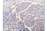 The image on the left is immunohistochemistry of paraffin-embedded Human liver cancer tissue using CSB-PA945457(CLEC10A Antibody) at dilution 1/25, on the right is treated with fusion protein. (Original magnification: 