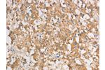 The image on the left is immunohistochemistry of paraffin-embedded Human thyroid cancer tissue using CSB-PA945784(ART3 Antibody) at dilution 1/40, on the right is treated with fusion protein. (Original magnification: 