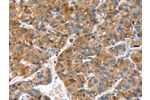 The image on the left is immunohistochemistry of paraffin-embedded Human liver cancer tissue using CSB-PA945809(GINS1 Antibody) at dilution 1/25, on the right is treated with synthetic peptide. (Original magnification: 