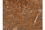The image on the left is immunohistochemistry of paraffin-embedded Human liver cancer tissue using CSB-PA945984(CDK19 Antibody) at dilution 1/70, on the right is treated with synthetic peptide. (Original magnification: 