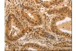 The image on the left is immunohistochemistry of paraffin-embedded Human colon cancer tissue using CSB-PA946457(ADRA1B Antibody) at dilution 1/20, on the right is treated with synthetic peptide. (Original magnification: 