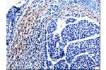The image on the left is immunohistochemistry of paraffin-embedded Human liver cancer tissue using CSB-PA947265(CDC20 Antibody) at dilution 1/10, on the right is treated with fusion protein. (Original magnification: 