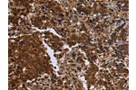 The image on the left is immunohistochemistry of paraffin-embedded Human liver cancer tissue using CSB-PA947469(FMN2 Antibody) at dilution 1/30, on the right is treated with synthetic peptide. (Original magnification: 