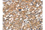 The image on the left is immunohistochemistry of paraffin-embedded Human thyroid cancer tissue using CSB-PA947781(CDH5 Antibody) at dilution 1/50, on the right is treated with synthetic peptide. (Original magnification: 