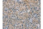 The image on the left is immunohistochemistry of paraffin-embedded Human liver cancer tissue using CSB-PA948042(CAB39L Antibody) at dilution 1/30, on the right is treated with fusion protein. (Original magnification: 