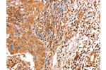 The image on the left is immunohistochemistry of paraffin-embedded Human cervical cancer tissue using CSB-PA948378(ACAD9 Antibody) at dilution 1/10, on the right is treated with fusion protein. (Original magnification: 
