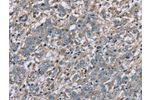 The image on the left is immunohistochemistry of paraffin-embedded Human liver cancer tissue using CSB-PA949422(FAP Antibody) at dilution 1/30, on the right is treated with fusion protein. (Original magnification: 