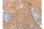 The image on the left is immunohistochemistry of paraffin-embedded Human cervical cancer tissue using CSB-PA949432(ABCA2 Antibody) at dilution 1/25, on the right is treated with synthetic peptide. (Original magnification: 