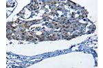 The image on the left is immunohistochemistry of paraffin-embedded Human breast cancer tissue using CSB-PA949748(BPIFB1 Antibody) at dilution 1/25, on the right is treated with synthetic peptide. (Original magnification: 