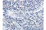The image on the left is immunohistochemistry of paraffin-embedded Human lung cancer tissue using CSB-PA950095(CCNE1 Antibody) at dilution 1/5, on the right is treated with synthetic peptide. (Original magnification: 