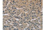 The image on the left is immunohistochemistry of paraffin-embedded Human liver cancer tissue using CSB-PA950350(CYR61 Antibody) at dilution 1/60, on the right is treated with fusion protein. (Original magnification: 