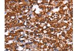 The image on the left is immunohistochemistry of paraffin-embedded Human thyroid cancer tissue using CSB-PA950411(GAGE12I Antibody) at dilution 1/30, on the right is treated with synthetic peptide. (Original magnification: 