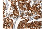 The image on the left is immunohistochemistry of paraffin-embedded Human breast cancer tissue using CSB-PA950500(AGO4 Antibody) at dilution 1/25, on the right is treated with synthetic peptide. (Original magnification: 