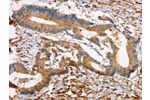 The image on the left is immunohistochemistry of paraffin-embedded Human colon cancer tissue using CSB-PA950736(DPYSL2 Antibody) at dilution 1/45, on the right is treated with synthetic peptide. (Original magnification: 