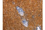 The image on the left is immunohistochemistry of paraffin-embedded Human cervical cancer tissue using CSB-PA951077(DCT Antibody) at dilution 1/25, on the right is treated with fusion protein. (Original magnification: 