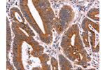 The image on the left is immunohistochemistry of paraffin-embedded Human colon cancer tissue using CSB-PA951162(CRISP3 Antibody) at dilution 1/40, on the right is treated with fusion protein. (Original magnification: 