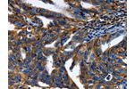 The image on the left is immunohistochemistry of paraffin-embedded Human ovarian cancer tissue using CSB-PA951195(ABCC5 Antibody) at dilution 1/50, on the right is treated with synthetic peptide. (Original magnification: 