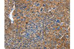 The image on the left is immunohistochemistry of paraffin-embedded Human liver cancer tissue using CSB-PA951577(AUP1 Antibody) at dilution 1/50, on the right is treated with fusion protein. (Original magnification: 