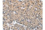 The image on the left is immunohistochemistry of paraffin-embedded Human liver cancer tissue using CSB-PA952156(DSC1 Antibody) at dilution 1/40, on the right is treated with synthetic peptide. (Original magnification: 