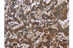 The image on the left is immunohistochemistry of paraffin-embedded Human liver cancer tissue using CSB-PA952632(FMR1 Antibody) at dilution 1/30, on the right is treated with fusion protein. (Original magnification: 