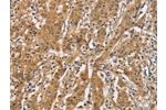 The image on the left is immunohistochemistry of paraffin-embedded Human gastic cancer tissue using CSB-PA952668(CDCP1 Antibody) at dilution 1/50, on the right is treated with synthetic peptide. (Original magnification: 