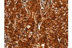 The image on the left is immunohistochemistry of paraffin-embedded Human gastic cancer tissue using CSB-PA952743(BCAS3 Antibody) at dilution 1/40, on the right is treated with synthetic peptide. (Original magnification: 