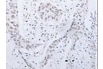 The image on the left is immunohistochemistry of paraffin-embedded Human esophagus cancer tissue using CSB-PA952756(CCND2 Antibody) at dilution 1/20, on the right is treated with synthetic peptide. (Original magnification: 