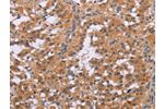 The image on the left is immunohistochemistry of paraffin-embedded Human thyroid cancer tissue using CSB-PA952871(CDK1 Antibody) at dilution 1/20, on the right is treated with synthetic peptide. (Original magnification: 