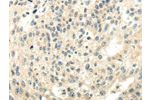 The image on the left is immunohistochemistry of paraffin-embedded Human breast cancer tissue using CSB-PA952927(CYP19A1 Antibody) at dilution 1/35, on the right is treated with synthetic peptide. (Original magnification: 