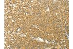 The image on the left is immunohistochemistry of paraffin-embedded Human lymphoma tissue using CSB-PA953606(AARS2 Antibody) at dilution 1/40, on the right is treated with fusion protein. (Original magnification: 