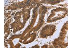 The image on the left is immunohistochemistry of paraffin-embedded Human colon cancer tissue using CSB-PA953662(DUSP8 Antibody) at dilution 1/30, on the right is treated with synthetic peptide. (Original magnification: 