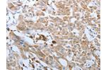 The image on the left is immunohistochemistry of paraffin-embedded Human lung cancer tissue using CSB-PA954065(FGF1 Antibody) at dilution 1/50, on the right is treated with synthetic peptide. (Original magnification: 