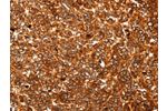 The image on the left is immunohistochemistry of paraffin-embedded Human ovarian cancer tissue using CSB-PA955823(ALDOA Antibody) at dilution 1/30, on the right is treated with fusion protein. (Original magnification: 