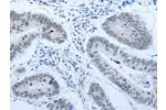 The image on the left is immunohistochemistry of paraffin-embedded Human colon cancer tissue using CSB-PA956054(ACIN1 Antibody) at dilution 1/30, on the right is treated with synthetic peptide. (Original magnification: 