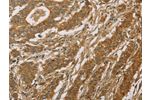 The image on the left is immunohistochemistry of paraffin-embedded Human gastic cancer tissue using CSB-PA956260(CYP39A1 Antibody) at dilution 1/50, on the right is treated with fusion protein. (Original magnification: 