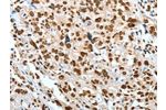 The image on the left is immunohistochemistry of paraffin-embedded Human esophagus cancer tissue using CSB-PA956646(BNIP1 Antibody) at dilution 1/60, on the right is treated with fusion protein. (Original magnification: 