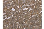 The image on the left is immunohistochemistry of paraffin-embedded Human ovarian cancer tissue using CSB-PA957321(CERS4 Antibody) at dilution 1/35, on the right is treated with synthetic peptide. (Original magnification: 