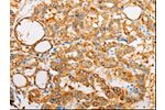 The image on the left is immunohistochemistry of paraffin-embedded Human thyroid cancer tissue using CSB-PA957575(ARF1 Antibody) at dilution 1/25, on the right is treated with synthetic peptide. (Original magnification: 